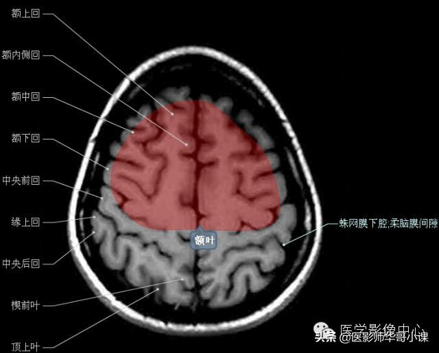 颅脑mri(头部MRI)插图(24)