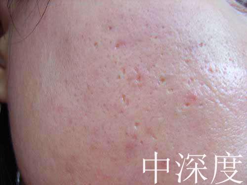 痘坑一辈子都不会好吗，激光祛痘印痘坑多少钱一次（能否选择‘’无恢复期‘’的治疗项目）