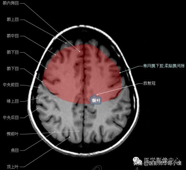 颅脑mri(头部MRI)插图(26)