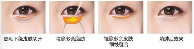 大眼袋怎么消除，大眼袋怎么消除（整形医生教您如何去除“大眼袋”）