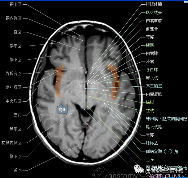 颅脑mri(头部MRI)插图(33)