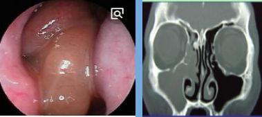 鼻窦炎微创手术，鼻窦炎微创手术价格是多少（诊治及【合理用药）