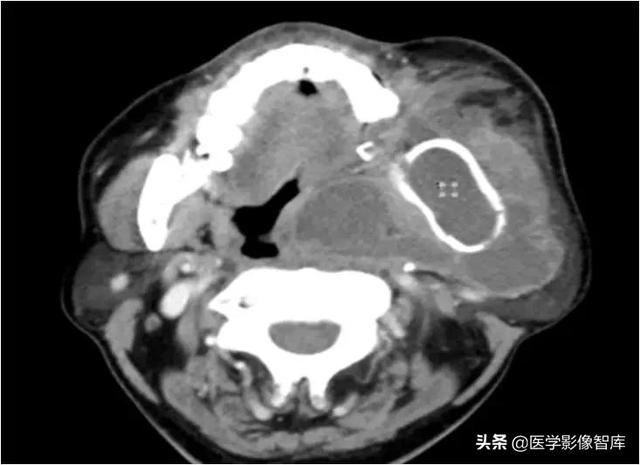 颞间隙感染，颞间隙感染切开部位（颌面部间隙感染影像诊断及各间隙解剖介绍）