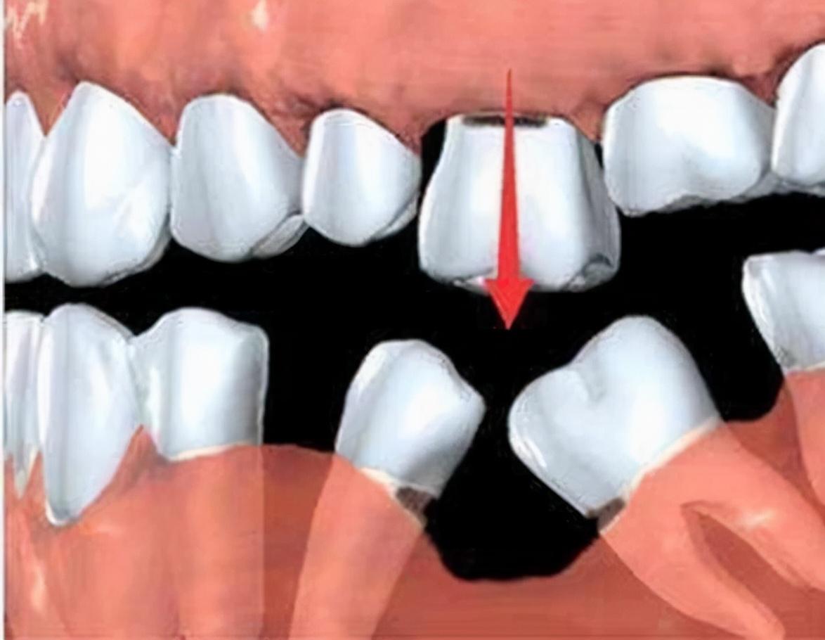 良心医生不建议种植牙镶牙,为什么60岁后不种植牙