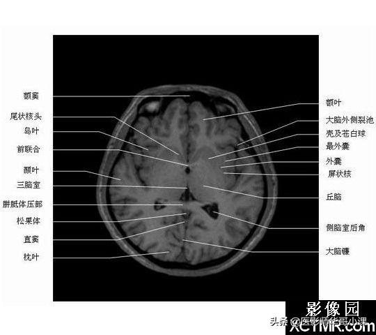 颅脑mri(头部MRI)插图(47)