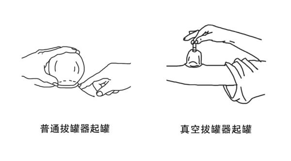 拔罐的坏处哪些人不能拔罐，拔罐虽好，但有5类人不适合
