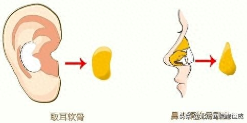 自体软骨隆鼻正确方法图片,自体软骨隆鼻可以永久的吗