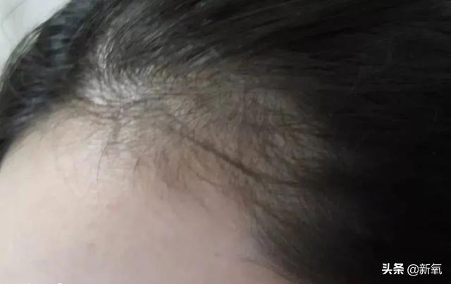 发际线粉会堵塞毛孔吗，发际线粉的危害（关晓彤才23岁就秃了）