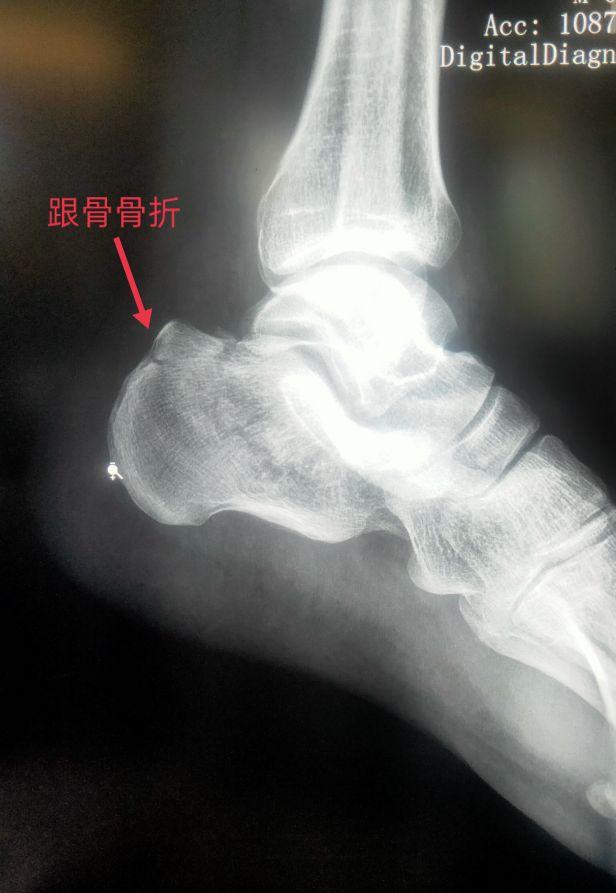 脚踝是哪个部位图解，脚踝是哪个部位图解视频（学习《X线读片指南》骨、关节系统——踝关节）