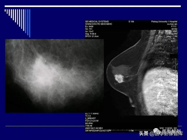 乳房解剖学基础知识，乳腺解剖及乳腺各病变影像诊断与鉴别