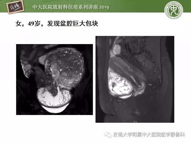 子宫颈影像解剖，子宫详细解剖及磁共振信号分析