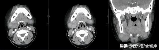 颞间隙感染，颞间隙感染切开部位（颌面部间隙感染影像诊断及各间隙解剖介绍）