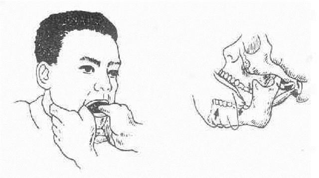 下巴掉了怎么复位，下巴闭口反复长怎么根治（下巴“掉”了怎么办）