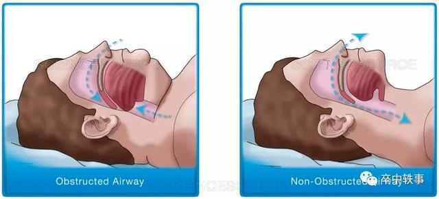 kg/m2是什么单位，kg是多重（脑卒中与体重大小的关系）