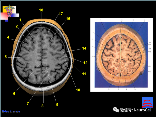 大脑结构图及功能图，人类大脑十大三维解剖图（脑局部解剖与功能图谱）