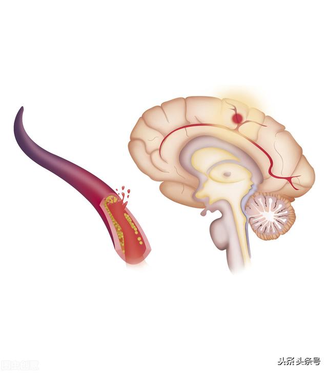 脂必泰的功效与作用，脂必泰胶囊功效与作用图片（调血脂、护血管、防治冠心病和脑卒中）