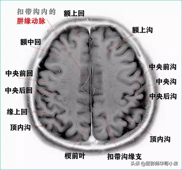 头颅ct解剖图，头部骨骼结构图（颅脑磁共振MRI解剖结构以及高清图谱）