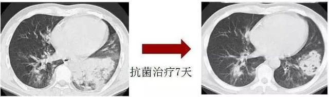 碘酒过期了还能用吗，过期了的碘酒还能不能用（硬扛3天不吃抗生素必后悔）