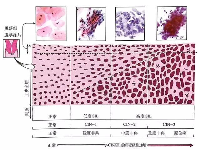 cin1级是什么意思(活检cin1级hpv阳性)插图(1)