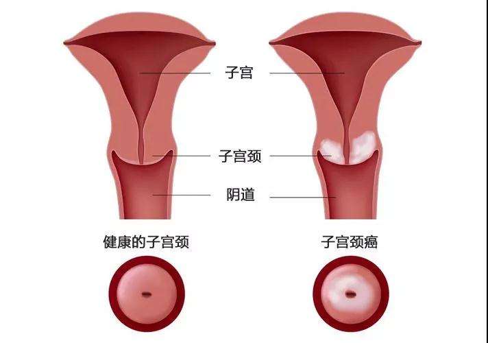 子宫是每个女性特征性器官,子宫颈位于子宫的最下部,发挥重要功能