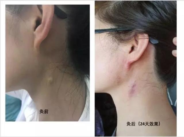 艾灸后可能会出现的十种症状，艾灸后出现的这些“不良反应”
