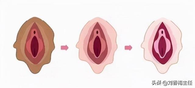 阴唇漂红手术缺点有哪些，漂唇后注意哪些怎么样护理（私密漂红有副作用吗）