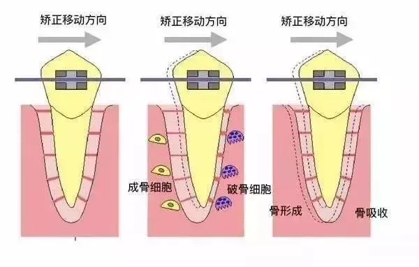 21岁一口烂牙很绝望，牙齿坏了一半里面都空了怎么办（戴牙套到底是个什么感受）