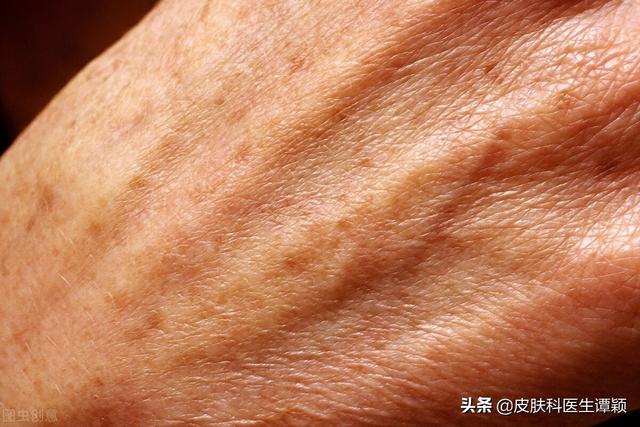 老年疣的去除方法，老年疣的去除方法 药（老年斑/脂溢性角化可以如何治疗）