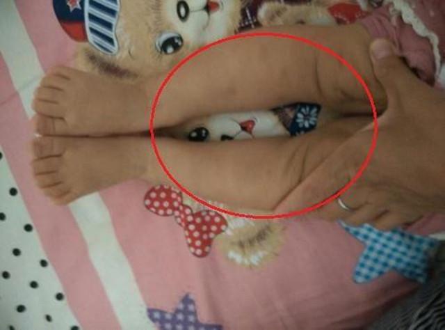 腿弯怎么办，会是“罗圈腿”吗（10岁孩子腿弯怎么办）