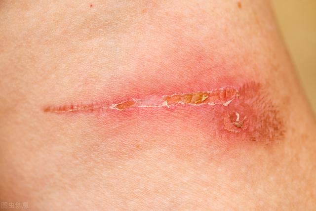 红色疤痕多久能恢复正常肤色，红色疤痕一般多久进入消退期（如何去掉结痂后的红印）