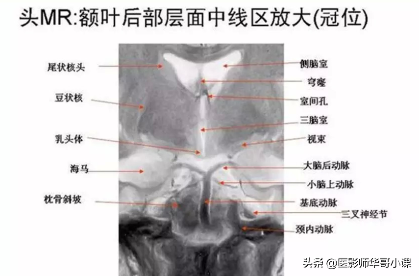 颅脑mri(头部MRI)插图(58)