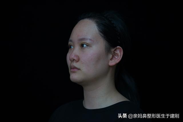 一张图看懂鼻基底凹陷对比图，塌鼻秒变立体质感鼻