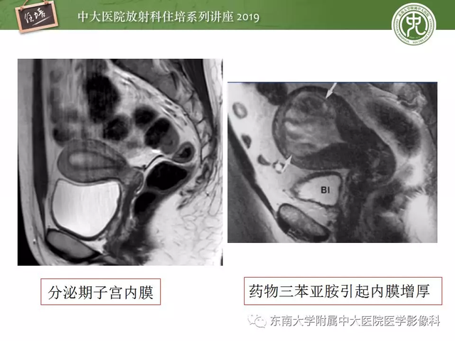 子宫颈影像解剖，子宫详细解剖及磁共振信号分析