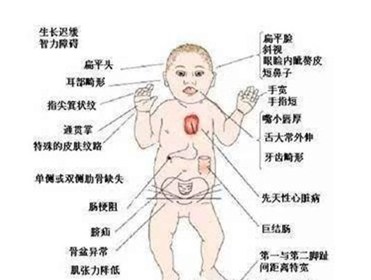 唐氏综合征是一种危害新生儿健康的疾病