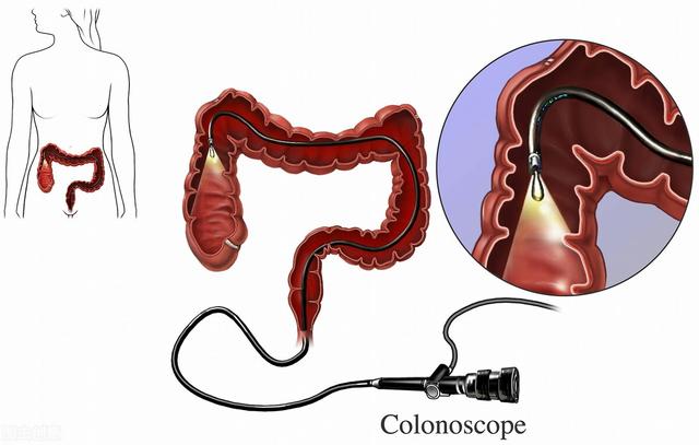 结肠镜和肠镜有什么区别吗，肠镜和结肠镜有区别吗（肠镜和肛肠镜虽有一字之差）