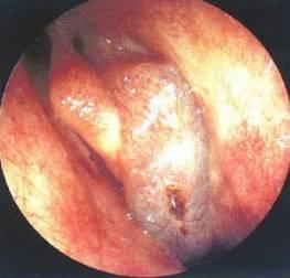 鼻窦炎微创手术，鼻窦炎微创手术价格是多少（诊治及【合理用药）