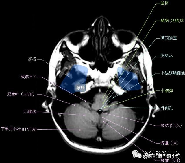 颅脑mri(头部MRI)插图(38)