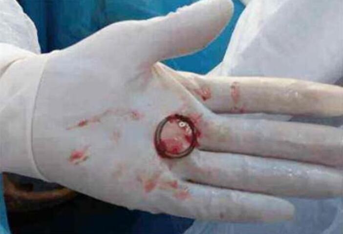 节育环带上18年未取,取出来后带还有肉渣,节育环什么时候取?