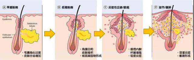 11岁女孩脸上长痘痘如何消除，11岁长青春痘怎么调理（怎样科学、安全的处理）