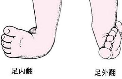 警惕宝宝足外翻，小孩子足外翻（足内翻或足外翻到底是什么）
