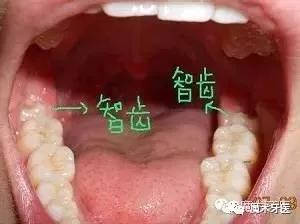 为什么牙医建议尽量不拔智齿，牙齿烂了一个洞很痛怎么办（作为牙医我坦诚爆料）