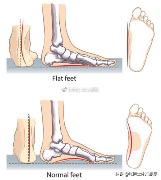 什么是扁平足，平底足怎么矫正（以及最优化的矫正训练方法）