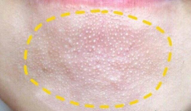 下巴长小痘痘的治疗方法，下巴长痘痘如何治疗（下巴凸起的“小颗粒”和痘痘怎么消除）