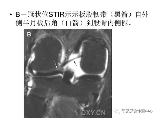 膝关节解剖结构图，膝盖解剖图示意图（膝关节MRI之正常解剖综述）