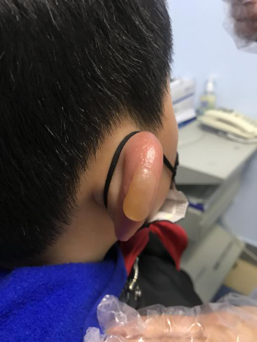 手冻裂了用什么药膏好，冬天手冻裂了怎么办（给您提个醒儿）