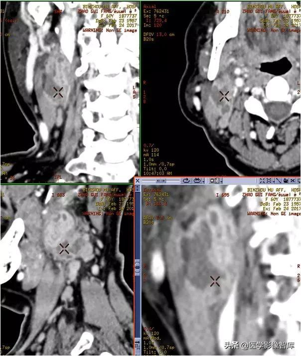 颞间隙感染，颞间隙感染切开部位（颌面部间隙感染影像诊断及各间隙解剖介绍）