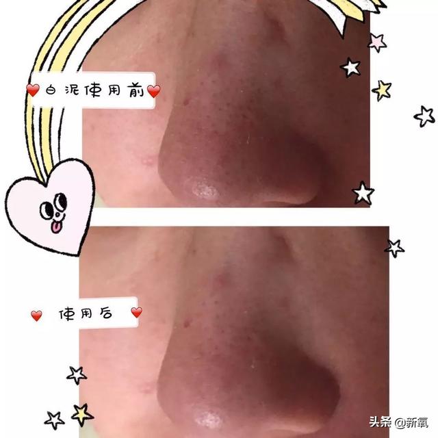 怎么去黑头小窍门，五个去黑头方法（我把火爆全网的去黑头方法试了一遍）