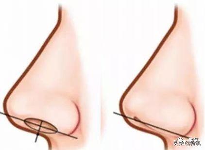 鼻翼收缩前后对比图，娜扎的鼻子怎么就歪掉了