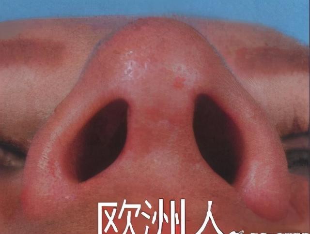 鼻头太大怎么办，鼻子大怎么才能小下来（如何改善鼻头肥大）