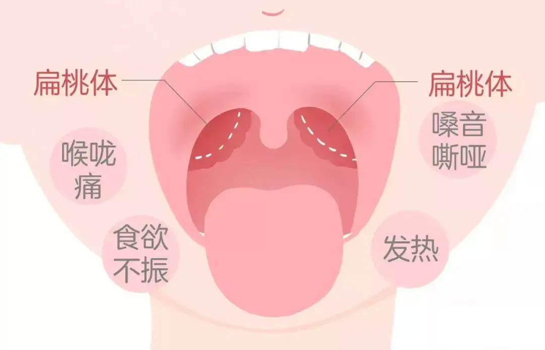 扁桃体发炎最怕三种水果柑橘(扁桃体发炎吃什么水果最有效的方法)